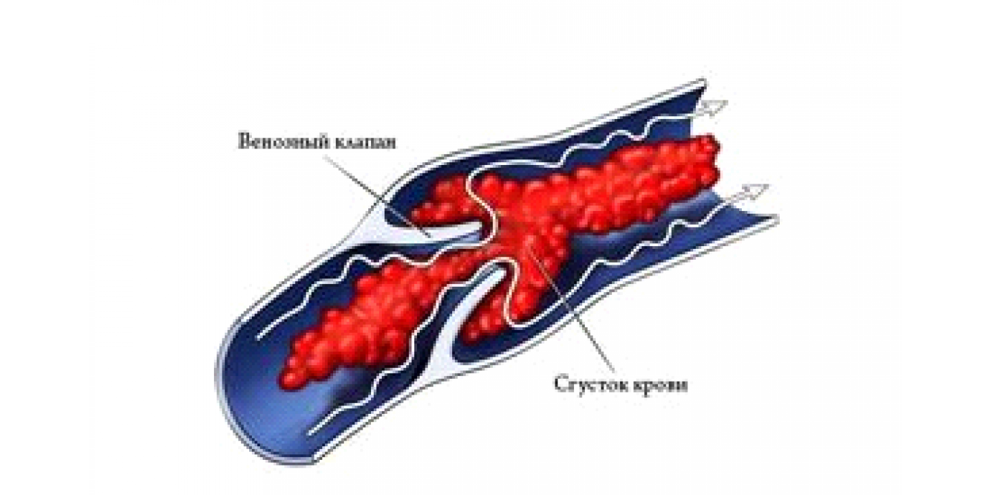 Флебит тромбофлебит флеботромбоз. Тромб обнаружение. Флебит тромбофлебит флеботромбоз. Тромб обнаружение. Тромб обнаружение.