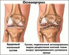 osteo plyus nsp